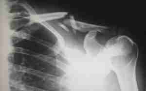 Frattura Femore Punti di Invalidità: quanti soldi sono ogni punto; cosa bisogna sapere e cosa bisogna fare.